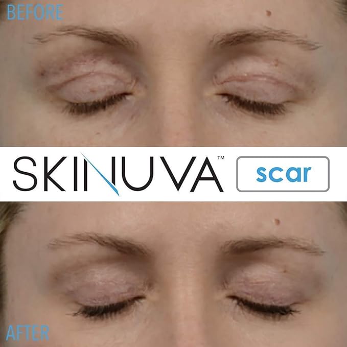 Skinuva® Next Generation Scar Cream - Advanced Scar Cream Formulated with Growth Factors (1 oz)