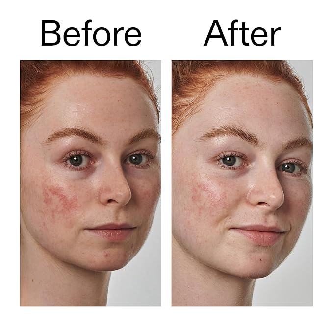 The INKEY List SuperSolutions Azelaic Acid 10% Serum, Fast-Absorbing Formula Helps Reduce Appearance of Redness and Soothes Skin, Leaves No White Cast, 1.01 fl oz