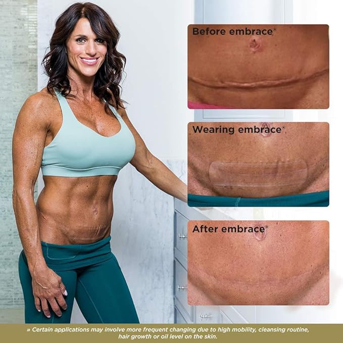 Embrace Active Scar Defense for New Scars, FDA-Cleared Medical-Grade Silicone Scar Sheets for Hypertrophic & Keloid Scar Treatment, 6.3 Inch, Extra-Large, 30-Day Supply