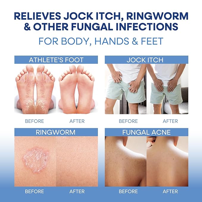 Hermon Antifungal Soap with Tea Tree Oil: Antifungal Bar Soothing Care & Relief of Itchy for Ringworm Jock Itch Athletes Foot - Body & Face Wash (1-Pack (2 Bars Original Tea Tree))