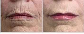 Lineless Eye cream removes crows feet, dark circles and Puffiness, fine lines. Anti-aging, anti-wrinkle and more. Also has 10% Reguage, 10% Syncoll, 8% Pepha-tight, DMAE, Glycerin and much more. PARABEN FREE 1 oz eye cream.