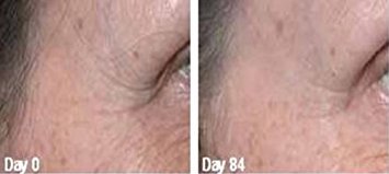 Lineless Eye cream removes crows feet, dark circles and Puffiness, fine lines. Anti-aging, anti-wrinkle and more. Also has 10% Reguage, 10% Syncoll, 8% Pepha-tight, DMAE, Glycerin and much more. PARABEN FREE 1 oz eye cream.
