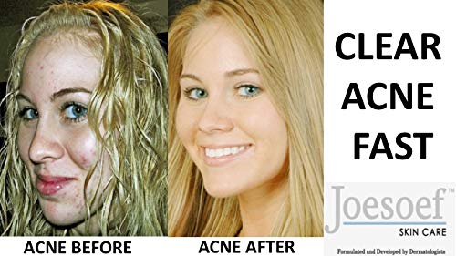 Joesoef Anti-Acne Soap, Natural Volcanic Sulfur 10%, for Oily to Normal Skin, 3.5-Ounces (Pack of 3)