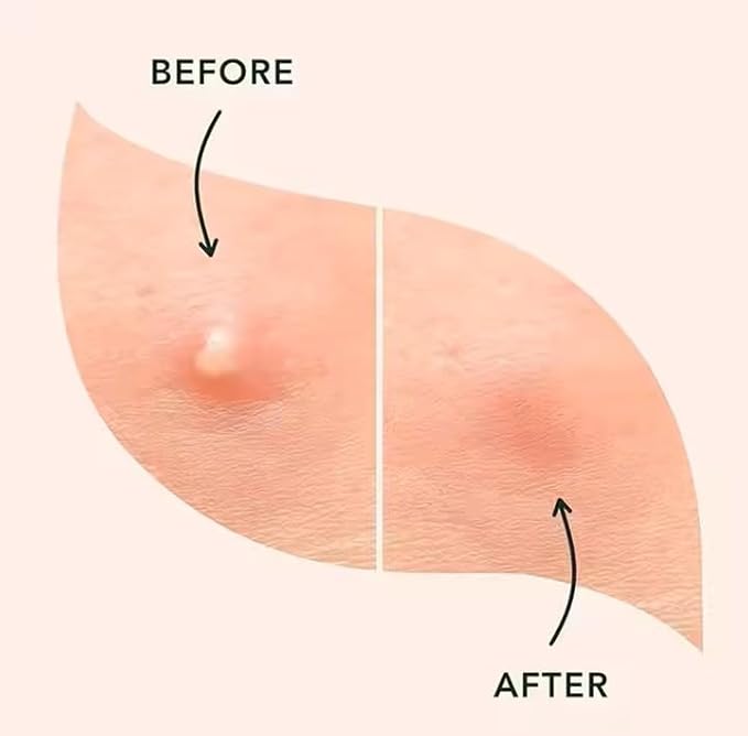 (3¢ Each) Pimple Patches 324 Pack - Hydrocolloid Acne Patches with Salicylic Acid & Tea Tree Oil - 4 Sizes S/M/L/XL - Face Acne Treatment - Easy Peel Perforated Sheets