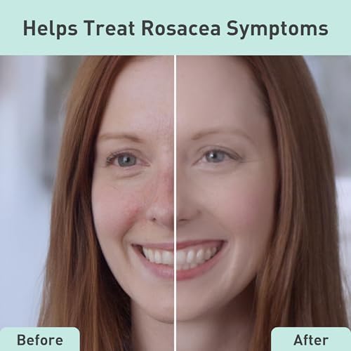 PROcure Rosacare Gentle Cream Cleanser – Hyaluronic Acid, Niacinamide & Licorice Root Face Wash for Sensitive, Redness-Prone Skin – Daily Use