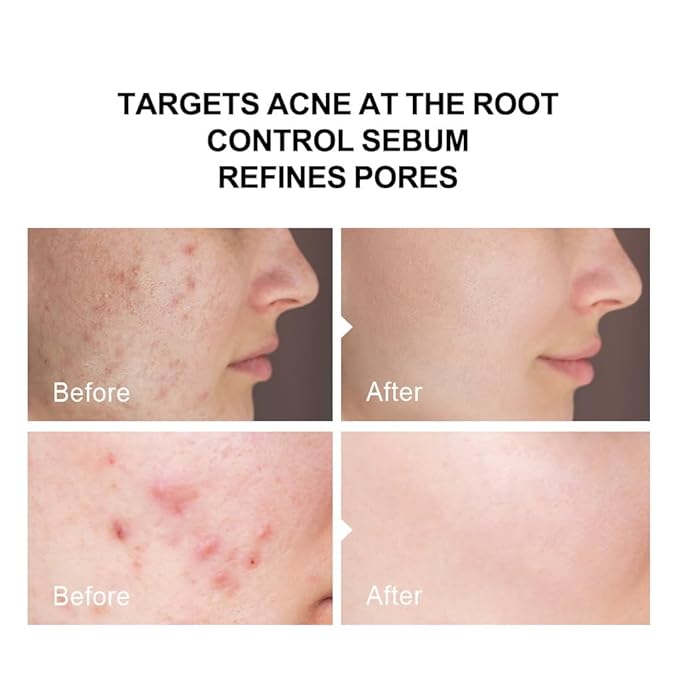 2% Salicylic Acid (BHA) Serum for Acne & Blackheads - Unclogs Pores, Oil Control, Sensitive-Skin Safe, Fragrance-Free,1 fl.oz