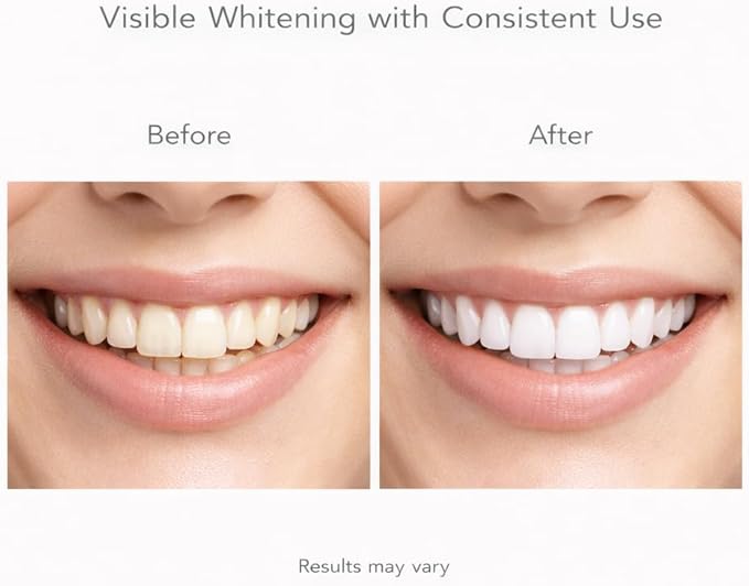 CALLSMILE Pro Whitening Gel - 4-6 Month Supply (2 oz) - Professional-Grade Hydrogen Peroxide Toothpaste Add-in - Up to 6 Shades Whiter in 30 Days - Easy Daily Use with Any Toothpaste