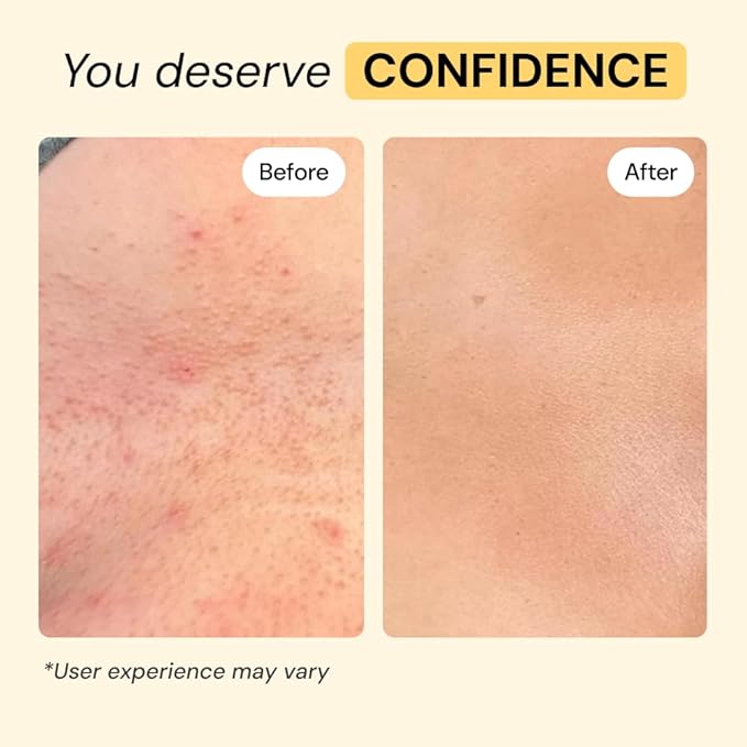 MyMagicHealer Universal Flare Care – Multi-Purpose Solution | Skin Flare-Ups - Hidradenitis Suppurativa, Folliculitis, Boils, Cysts | Anti-Chafing | Irritated Skin Relief w/Propolis & Egg Yolk 4 oz