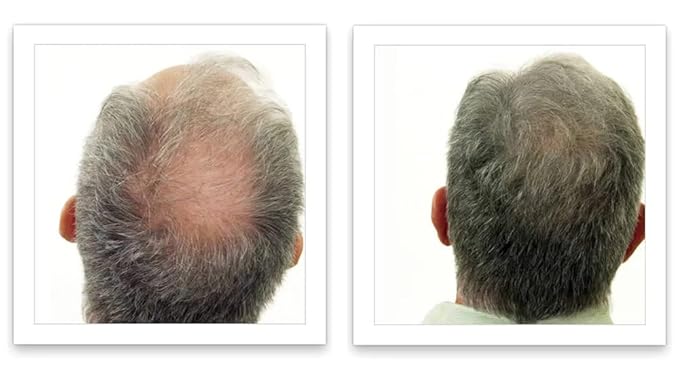 Caboki Hair Loss Concealer. All-Natural Hair Building Fiber. Make Thin Hair Look 10X Fuller Instantly. Eliminate the Appearance of Bald Spot and Thinning Hair (30G, 90-Day Supply). Gray