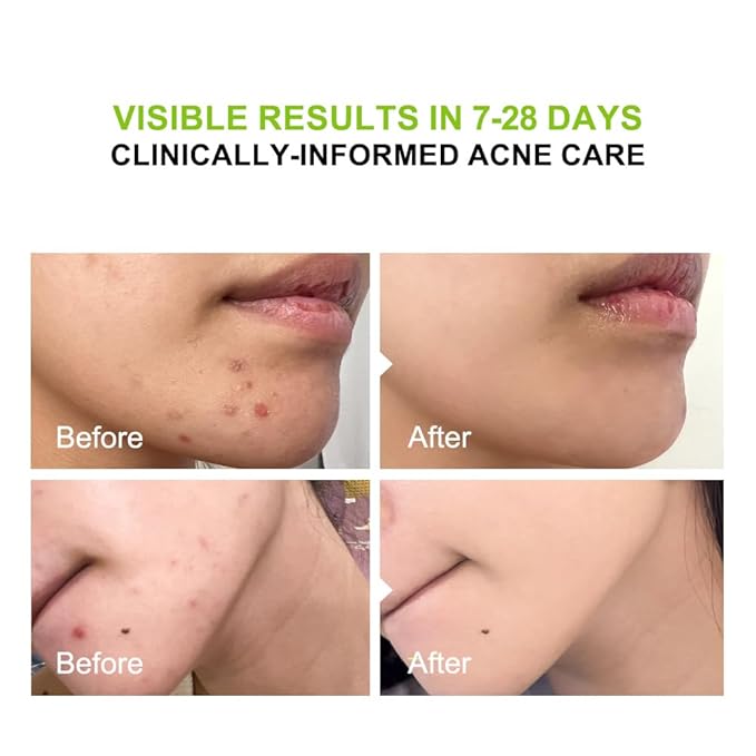 2% Salicylic Acid (BHA) Serum for Acne & Blackheads - Unclogs Pores, Oil Control, Sensitive-Skin Safe, Fragrance-Free,1 fl.oz