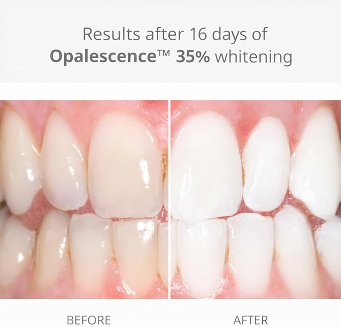 Opalescence 35% Gel Syringes Teeth Whitening - Refill Kit (12 Syringes Total) Carbamide Peroxide. Made by Ultradent, in Melon Flavor. Tooth Whitening Refill Syringes 5404-6
