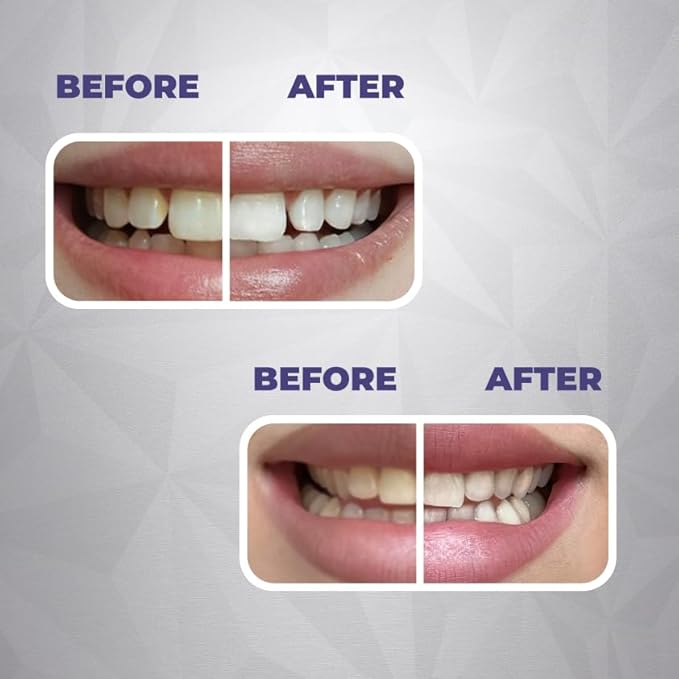 Whitening & Remineralization Teeth Strips | 14-Treatment Kit for Sensitive Teeth | Peroxide-Free Formula with Hydroxyapatite, Bischofite, Papain, Bromelain & Coconut Oil (28 Strips) Water Dent