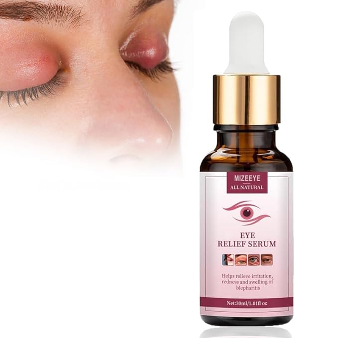 Styes Eye Relief Serum, 30ml Moisturize Blepharitis & Chalazion Remover, Gentle Under Eyelid Serum For Dark Circles, Puffiness.