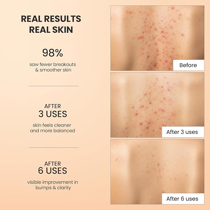 BellamiLuxx Body Acne Treatment Scrub: Helps Reduce Body Breakouts on Back, Chest, Butt & Thighs - Back Acne Treatment for Men, Women & Teens - Butt Acne Wash with Natural Actives for Smooth Skin