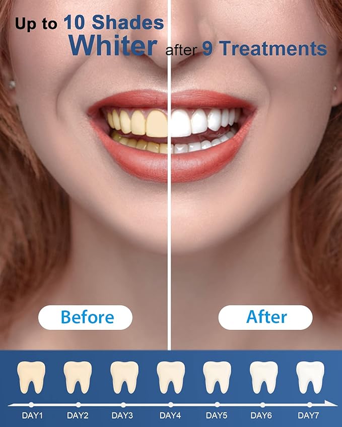 MySmile Teeth Whitening Gel Refills Pack, 6 Non-Sensitive Tooth Whitening Gel for White Teeth, Teeth Whitener Dental Grade Tooth Stain Remover for Tray, 10 min Fast Result Whitening