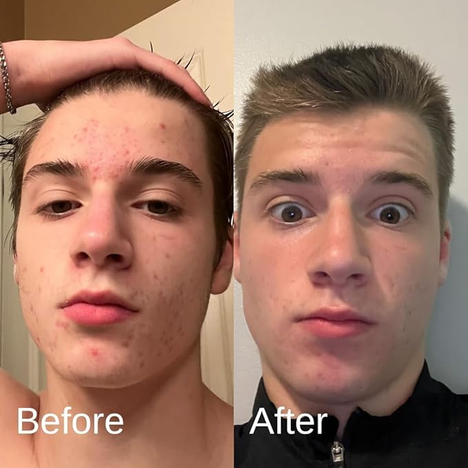 Acne System for Men and Boys, Face Wash, Moisturizer, Pimple Patches, Shield Men's Skin Care Set (4 Months)