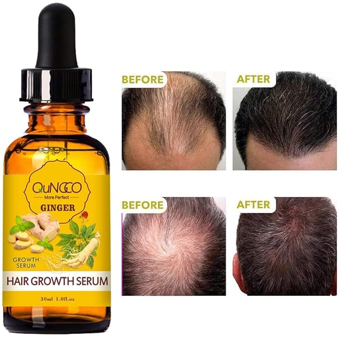 5 PACK Hair Growth Serum Liquid Hair Loss Treatment for Women & Men Dense Thicken Hair,Natural Ginger Essential Oil - Promotes Strong, Thick,Strengthens Hair - Nourishment For All Hair Types