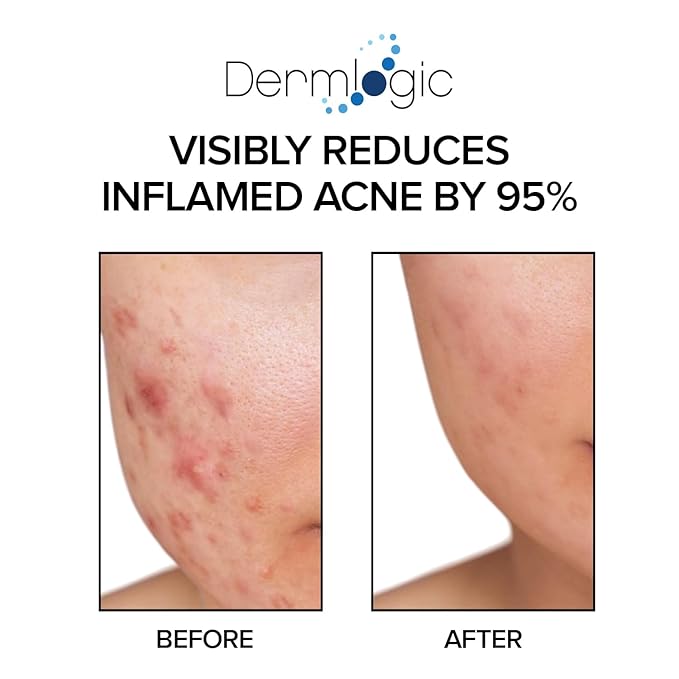Acne Treatment Pads- Contains Salicylic, Glycolic, & Lactic Acid for Face & Body. Clears Away Clogged Pores, Oily Skin & Cystic Breakouts. Removes Dark Spots, Blackhead & Whitehead Pimples