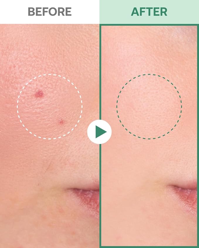 Yangyang Pine Quick Calming Spot Patch 12 Patches, Hyaluronic Acid Soothing Deep Shot, Blemish Relief, Pimples Care, Ultra-Thin Hydrocolloid Patch, Non-Irritating Acne Treatment