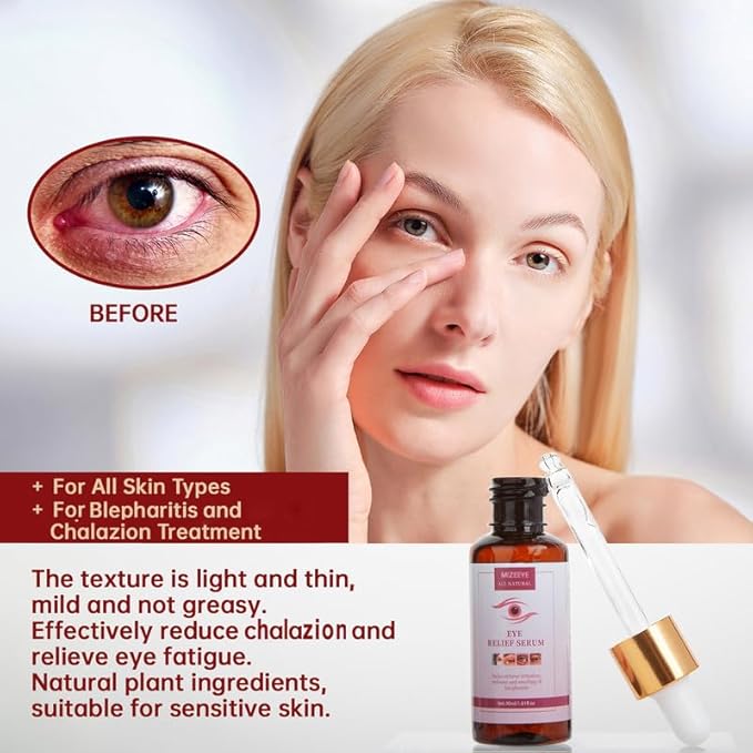 Styes Eye Relief Serum, 2PCS Moisturize Blepharitis & Chalazion Remover, Gentle Under Eyelid Serum For Dark Circles, Puffiness.