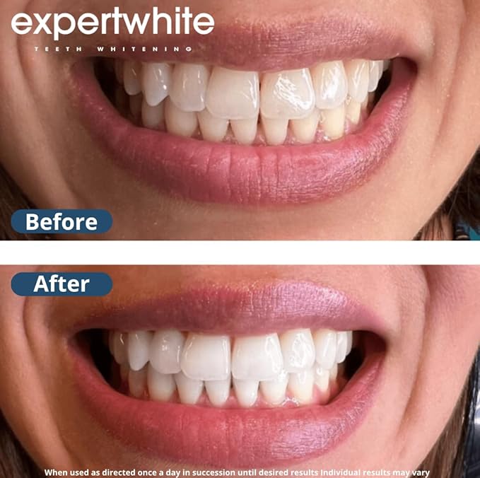 Expertwhite Teeth Whitening Gel Refills (6-gels). Made USA. 44 percent Carbamide Peroxide Tooth Bleaching Gel bleach For Invisalign style trays, Dental Grade Tooth Whitener. 6 syringes