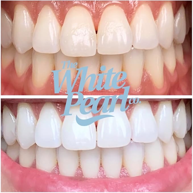 The White Pearl Co Teeth Whitening Kit with LED Light, Wireless, 35% Carbamide Peroxide, Desensitizing Agent, Enamel Safe, Gentle on Teeth