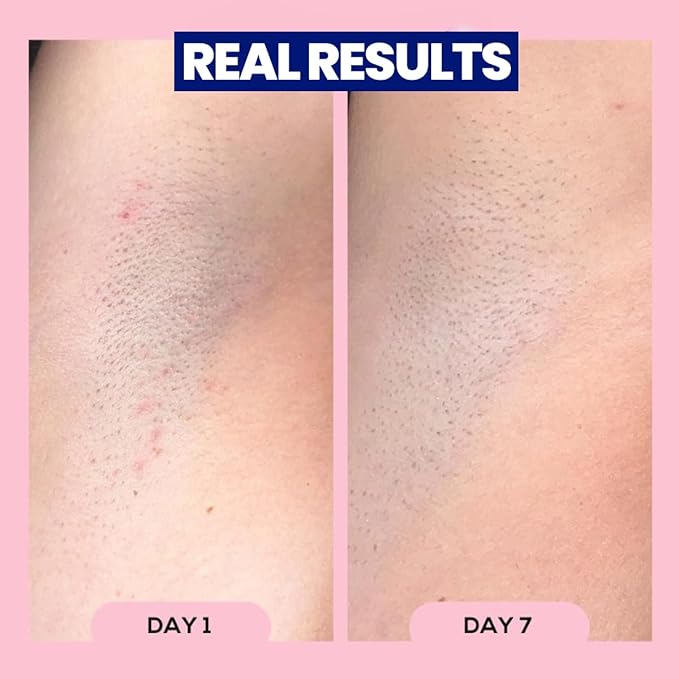 Megababe Après Shave | Post-Shave & Waxing | Ingrown Hair & Razor Bump Roll-On Treatment for Women | Bikini, Armpits & Legs (3.0 fl oz)