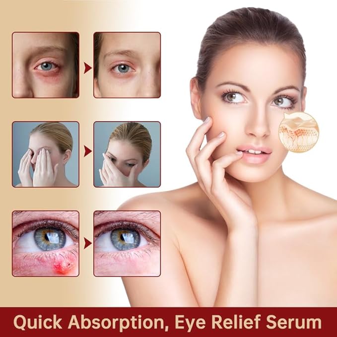 Styes Eye Relief Serum, 2PCS Moisturize Blepharitis & Chalazion Remover, Gentle Under Eyelid Serum For Dark Circles, Puffiness.