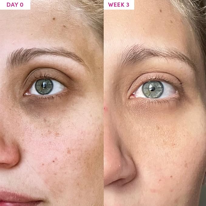 Sand & Sky Vitamin C Eye Cream Under Eye Patches Dark Circles Treatment - Peptides Hyaluronic Acid Eye Cream Anti Aging Under Eye Brightener, Eye Cream for Puffiness and Bags