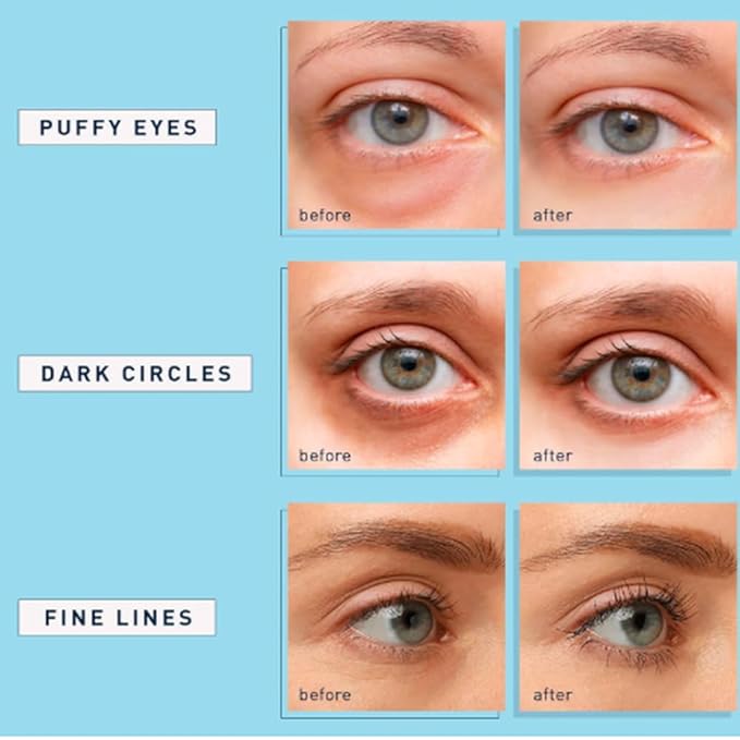 Under Eye Patches for Dark Circles & Puffiness – Hydrating Hydrogel Eye Patches with Niacinamide & Hyaluronic Acid, Cooling Undereye Eye Pads, 60 PCS (30 Pairs), Blue