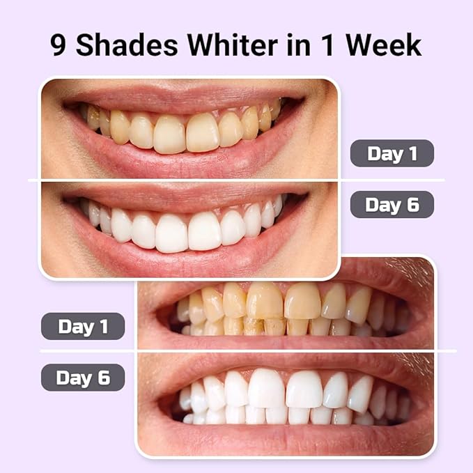 Puur Smile Teeth Whitening Kit – LED Light & Whitening Gel with Remineralization Syringes – Professional-Grade Whitening for Sensitive Teeth – Removes Stains from Coffee, Wine, & Smoking
