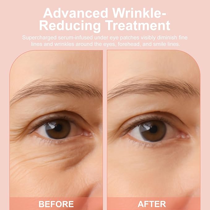 Micro Eye Patches, Under Eye Patches for Puffy Eyes, Dark Circles & Fine Lines, Deeply Hydrating Anti-Wrinkle Patches, Smooth Application Forehead & Smile Line Patches (1)