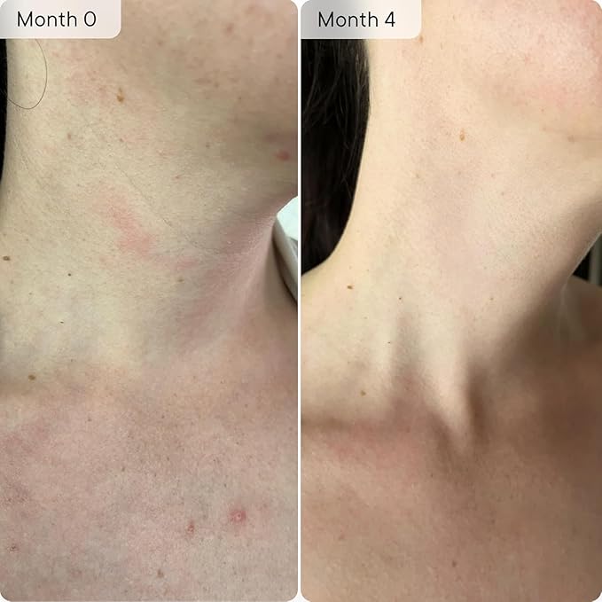 Qure Neck, Décolletage, Chest LED System, Red Light Therapy, 2 Wavelengths Red 633nm and Near-Infrared 830nm