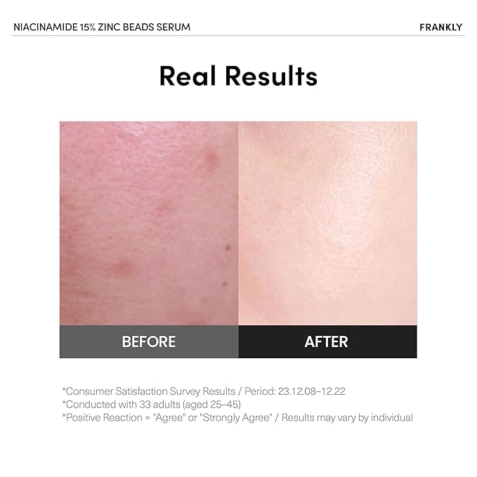 FRANKLY Niacinamide 15% + Zinc Bead Serum | High Dose Yet Gentle Skin Repair | Acne, Pore & Redness Control | Bead-to-Skin Delivery System for Fresh Niacinamide | Vegan Korean Skincare | 1.01 fl.oz