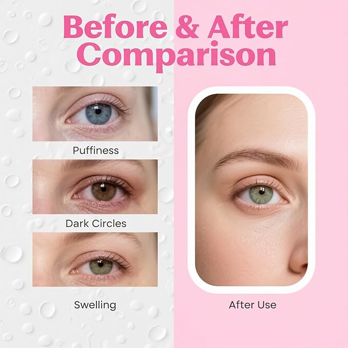 Eye Gel Pads, Ice Packs for Eyes, Under Eye Ice Pack, Gel Ice Pack, Cooling Eye Masks, Gel Eye Mask for Puffy Eyes, Migraine, Puffiness(6 pcs)