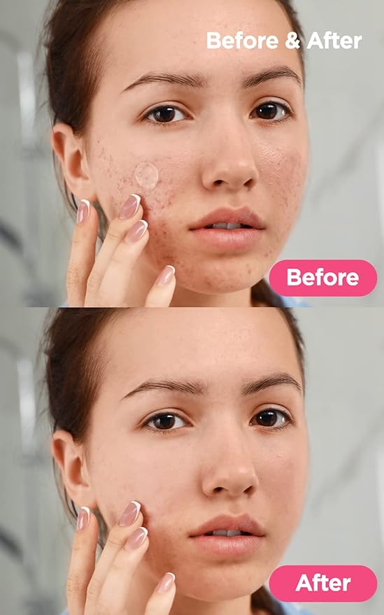 Neogen A-Clear Soothing Acne Care (2 Pack)