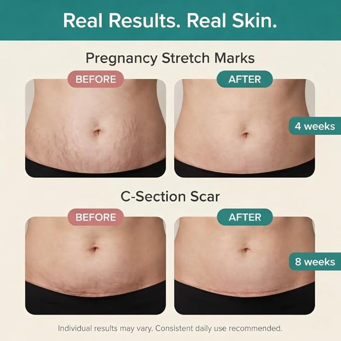 The Vibrant Glow, Pregnancy & Postpartum Oil for Stretch Marks & C-Section Scars, Deep Hydration for Stretching Skin, Doctor-Formulated Pure Oil Blend, Rosehip & Vitamin E, Dermatologist Tested, 2oz