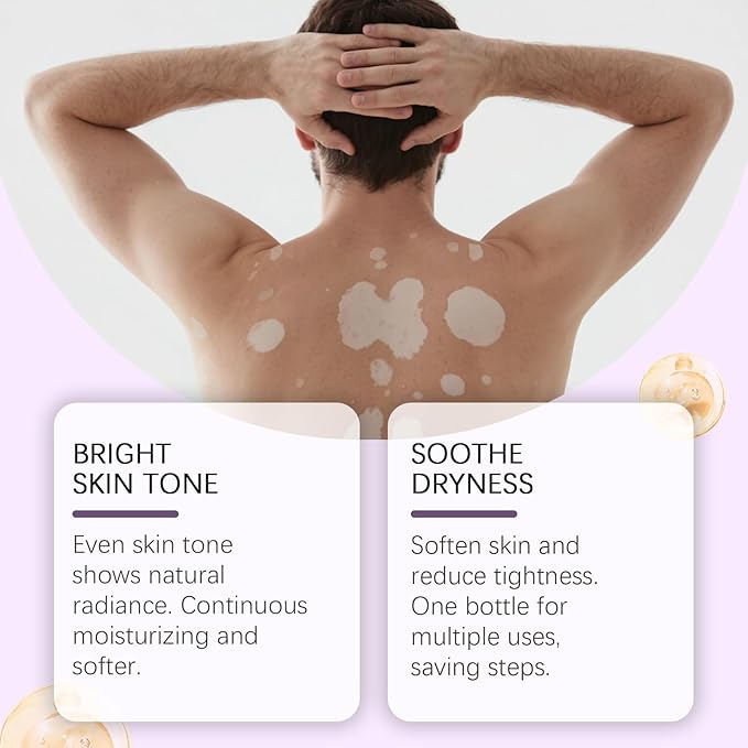 Vitiligo Cream, Vitiligo Treatment Cream， Reduce White Spots，Easy to Use