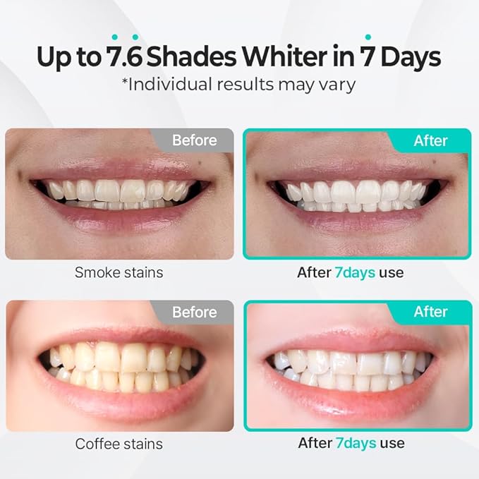 Live Orals PureDia Teeth Whitening Kit - Gel & Mouthpiece Set, Hydrogen Peroxide, Dentist Formulated for Sensitive Teeth, 28 Treatments.