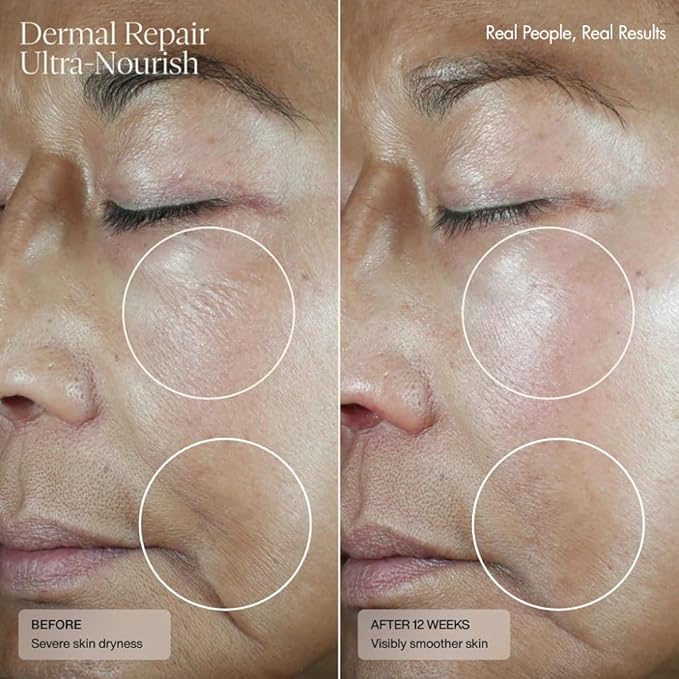 Senté Dermal Repair Ultra-Nourish - Rosacea Treatment For Dry, Sensitive Skin | Repairs, Replenishes & Reduces Skin Redness - 1.7 Fl Oz