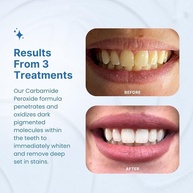 PurelyWHITE DELUXE Teeth Whitening Kit, Complete LED Teeth Whitening, 15+ Treatments, (3) 3ml Whitening Gel Syringes, Whiter Smile in 7 Minutes