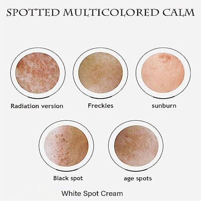 Japanese Melasma Cream, JP Yunnan Herbal White Spot Cream, Keting Face Cream, Face Moisturizing Face Skin Care (5pcs)