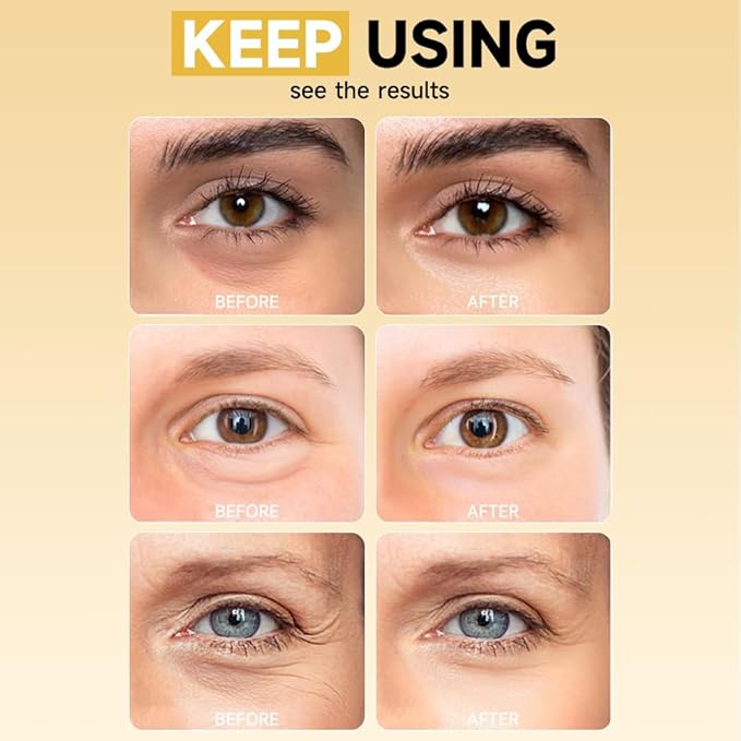 8 Pairs 5% PDRN Under Eye Patches, 6-in-1 Bio-Collagen 360° Eye Patches for puffy eyes, dark circles & Wrinkle | 2% Caffeine, Kojic acid, Retinol, Hyaluronic, Niacinamide | Korean Eye Care