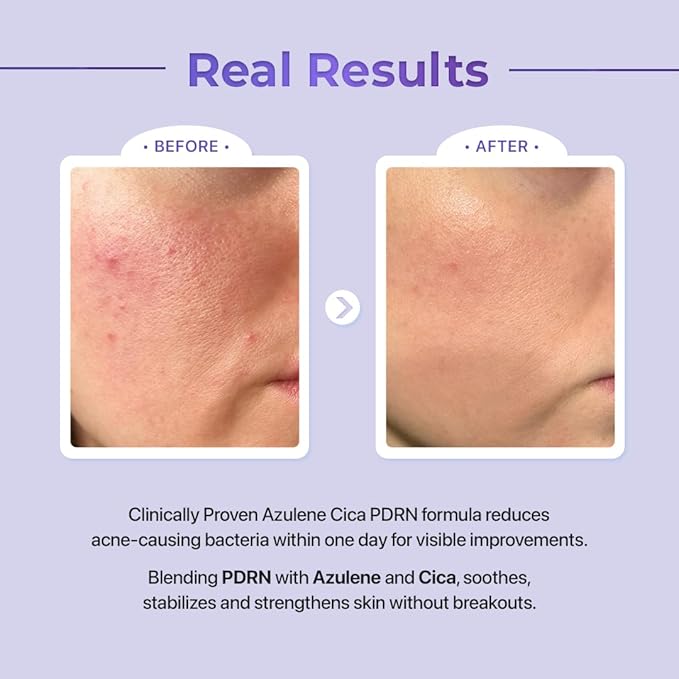 Le Nubele Azulene Cica PDRN Skin Regeneration Set (Serum + Ampoule + Gel Cream) 3-Step Skincare for Sensitive, Acne-Prone, and Aging Skin