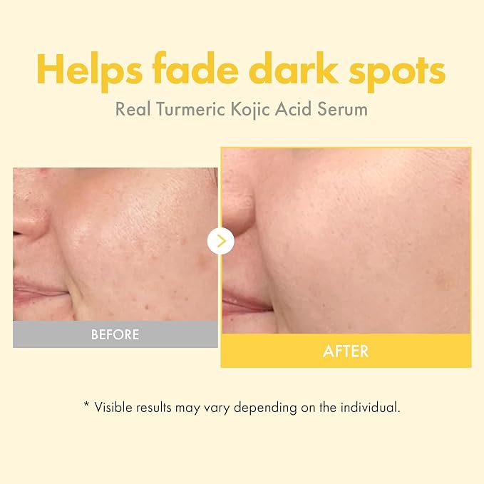 TOSOWOONG Real Turmeric Kojic Acid Serum - Brightening serum 7,000ppm Kojic Acid, 1,500ppm Turmeric, Alpha Arbutin, Astaxanthin, Glycolic Acid, Dark Spots, Freckle, Korean Skin Care, 33ml/1.11 fl.oz.