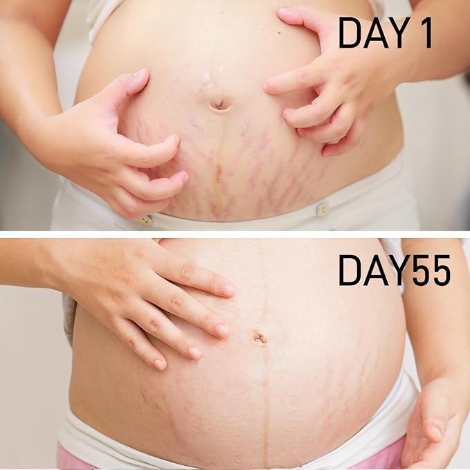 PEGO Stretch Mark Oil for Pregnancy, Maternity Body Oil for Stretch Mark Prevention & Reduction, Hydrating Skin Care, 4.06oz (2Pack)