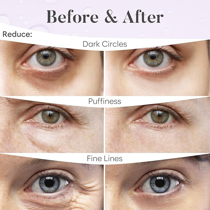 BLOOMORA Retinol & Collagen Under Eye Patches (30 Pairs) - For Dark Circles & Puffy Eyes - Eye Care Mask