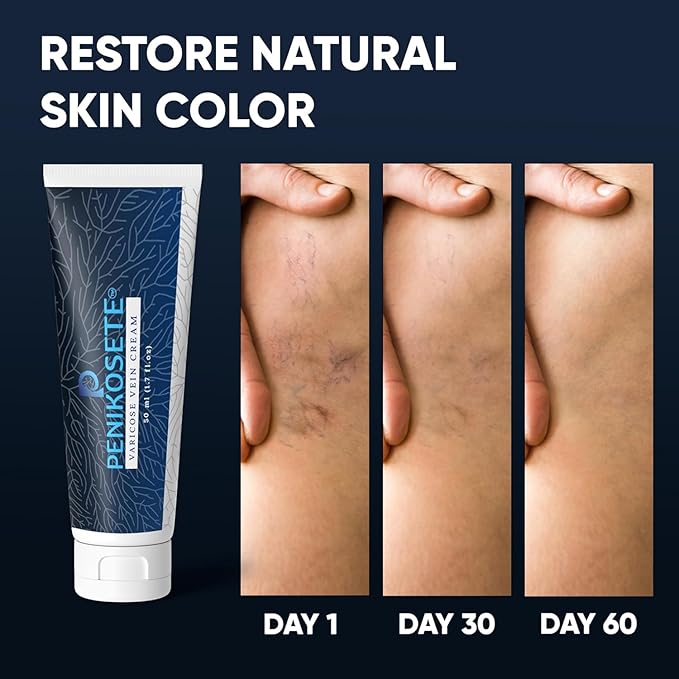Varicose & Spider Vein Cream for Men & Women | Ayurvedic Ashwagandha Formula for Circulation, Swelling & Tired Restless Legs | Natural, Non-Sticky for Healthy-Looking, Energized Legs!