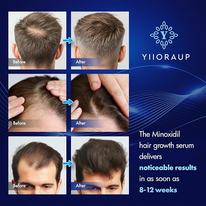 5% Minoxidil Hair Growth for Men and Women: Extra Strength Minoxidil Topical Solution for Adults with Receding Hairlines or Vertex Thinning - Hair Loss Treatment Serum with Biotin for Daily Scalp Use