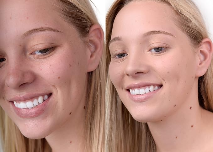 The Good Mineral Loves-You-Back 3in1 Mineral Powder Foundation (BEIGE 1) | Designed for Rosacea, Acne-Prone, Sensitive Skin | 3IN1 Concealer, Powder + Foundation | Non-Caking, Non-Drying